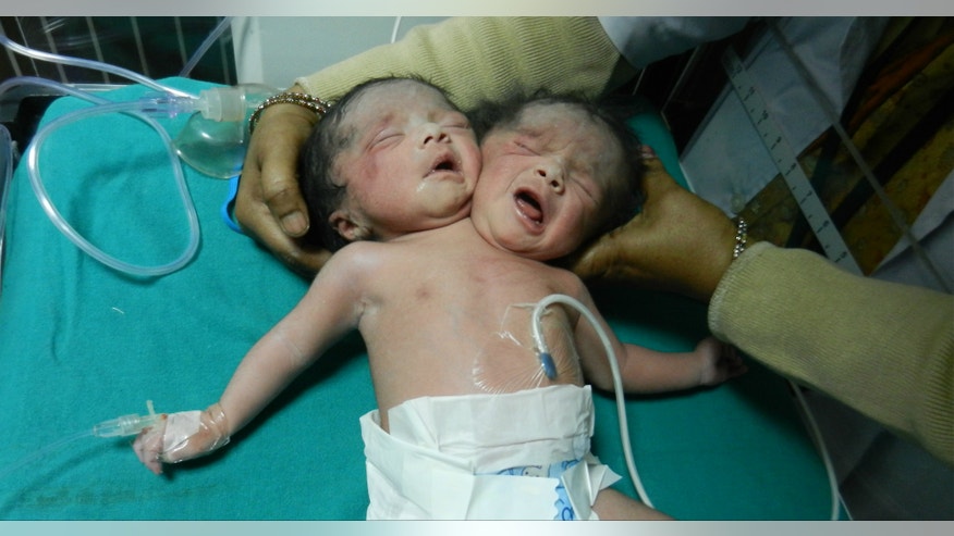 Two Headed Baby.jpg